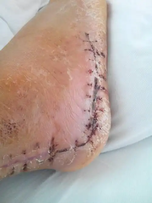 脚后跟粉碎性骨折,要是评不了残是不是没有赔偿