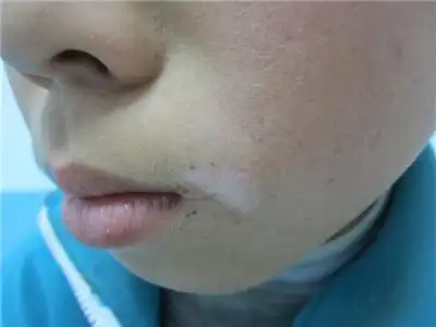 是不住院,不开刀,无痛苦,不留疤痕,花钱少,只需60分钟,白斑无影无踪