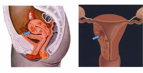 高强度超声聚焦技术治疗子宫腺肌病