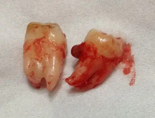 【重口杰宝慎入】拔完智齿三个多小时了.麻药还没消,但是喉咙无比疼痛