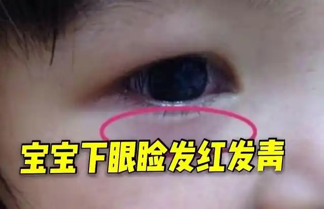 孩子眼袋发青,经常流鼻涕,原因?