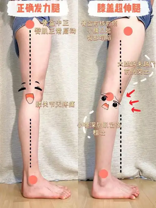 大腿前凸,小腿肚走路酸胀,膝盖内扣,xo型腿这些问题都有可能是因膝盖