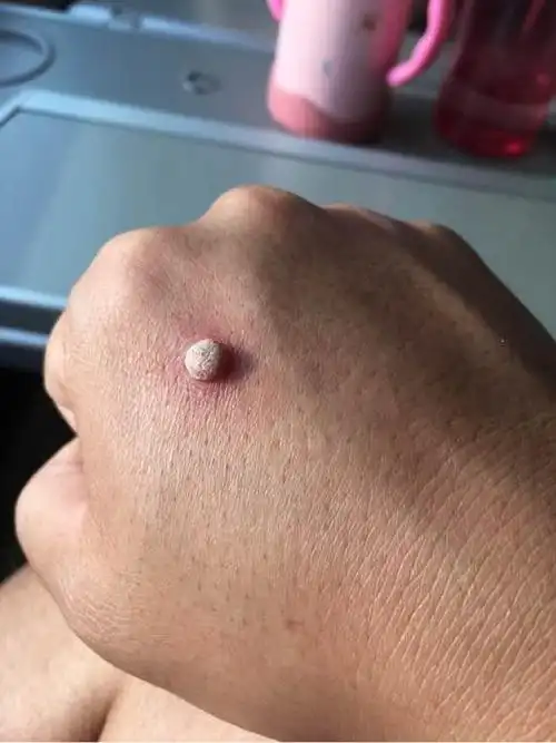 身上有难看的瘊子别急!滴一滴它,9天告别烦人小肉粒