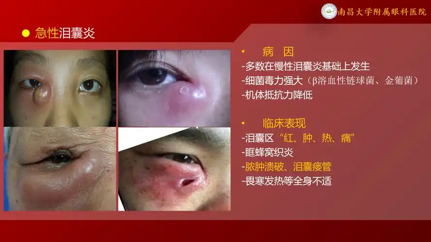 泪囊炎如何治疗