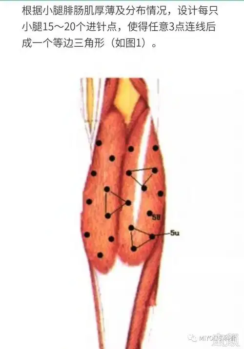 针【肉毒素瘦腿肌】    目标肌肉为腓肠肌,于站立位进行注射前的设计