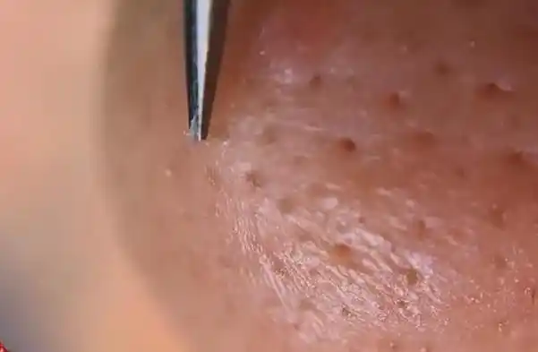 q: 鼻子上挤出的"白色物体"到底是什么?