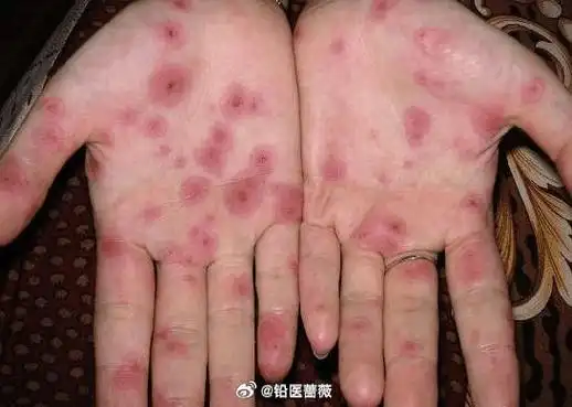 2岁宝宝疑因奶奶嚼碎喂食感染梅毒