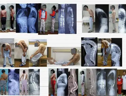 一组重度脊柱畸形病例原创