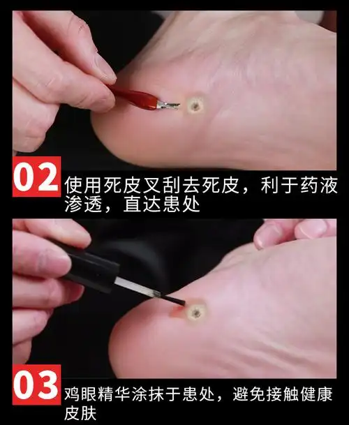 云南本草鸡眼膏去除手足部脚底瘊子老茧肉刺根脚趾疣去