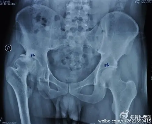 什么是髋关节骨性关节炎?