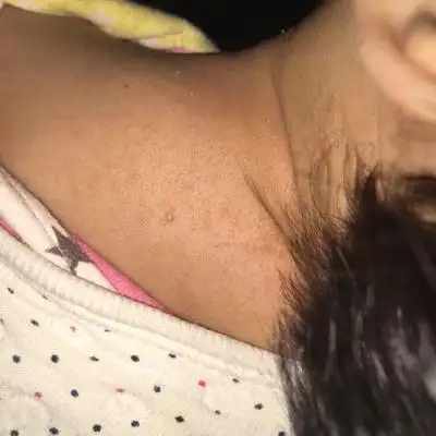 宝宝得了传染性软疣 去医院医生给开了重组人干扰素a2b软膏 抹了两天