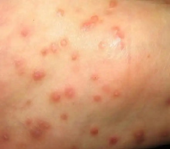 足部黄色瘤病图片