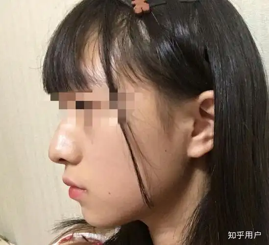 下巴后缩怎么办 如图? - 知乎