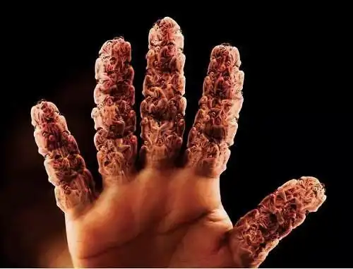 防治痛风就是防治结石做好预防远离痛风跟结石