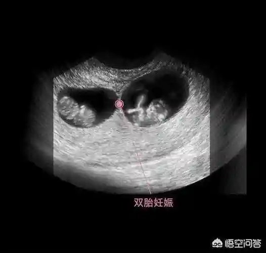 双胞胎症状孕妇怀有双胞胎4个症状很明显