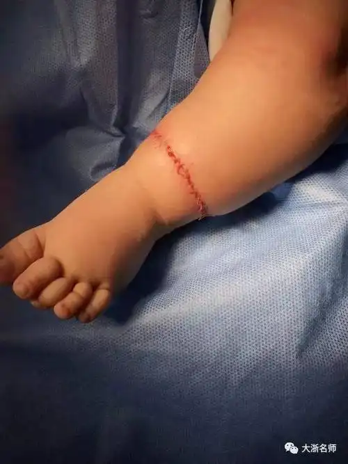 金华两个月婴儿上了手术台!未出生3根脚趾就被勒断!
