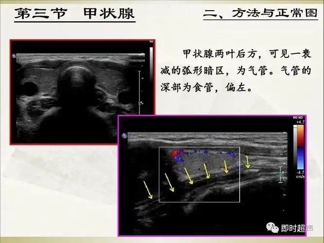 甲状腺超声诊断
