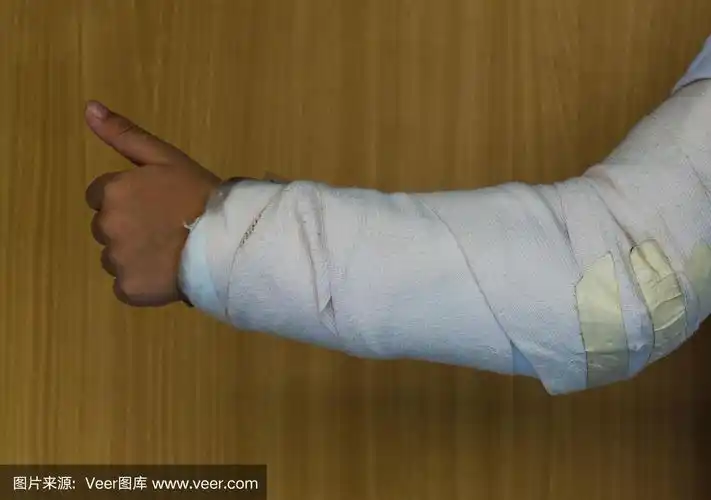 儿童手臂意外骨折