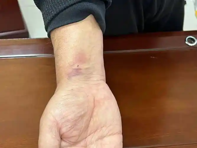 患者出院西北首例机器人冠脉介入治疗手术成功