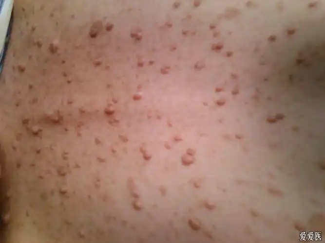 看图识病——典型的神经纤维瘤病 - 皮肤及性传播疾病讨论版 - 爱爱医
