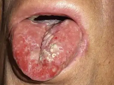 【病案】只需要"喷一喷"就可以治疗放射性口腔黏膜炎