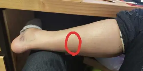 腓肠肌比目鱼肌撕裂