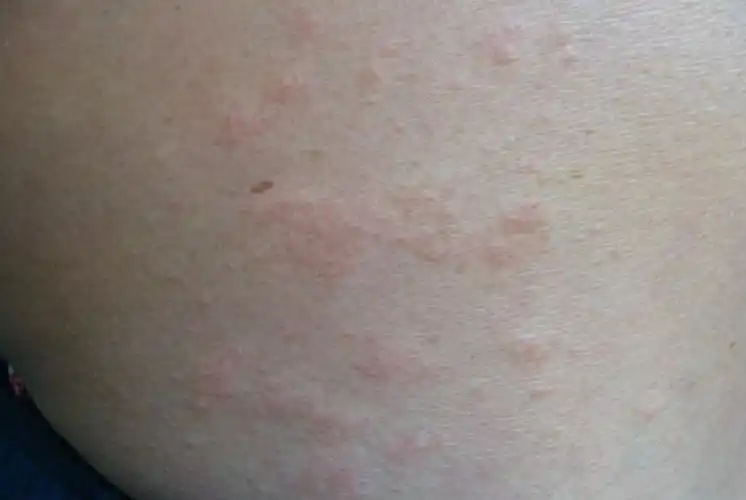 腿部夏季皮炎症状图片