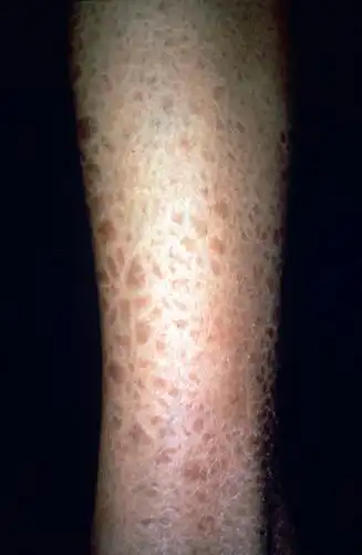 皮肤结节图片(结节病的皮肤改变)