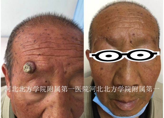 皮肤肿瘤 - 好大夫在线