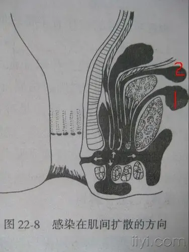 肛直环挂线的体验和认识