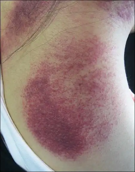 脖子响是怎么回事?刮痧来解决!