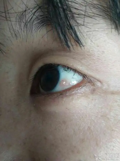 眼科专业讨论版 资源 相关疾病: 结膜炎