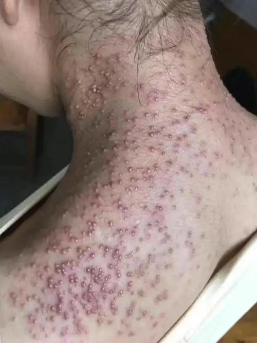 马拉色毛囊炎一例