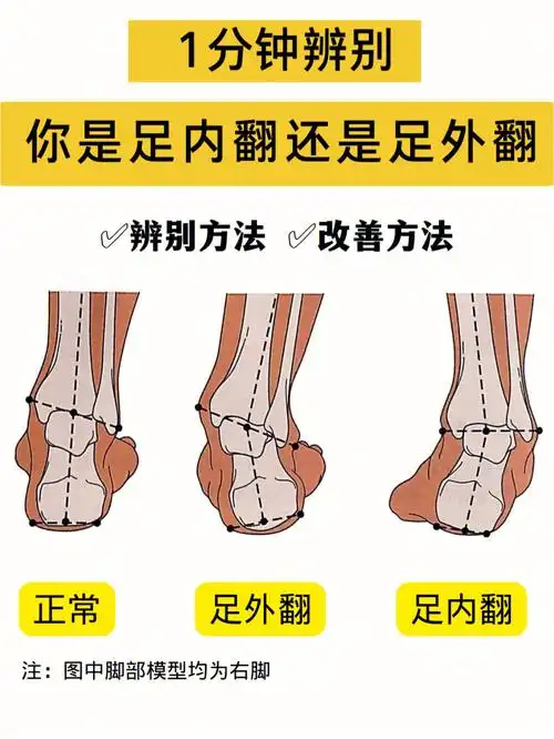 1分钟辨别你是足外翻还是足内翻附改善干