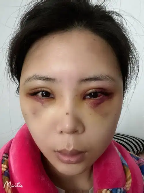 做了内切眼袋框格释放全脸填充现在眼周肿的厉害还有血肿如何快速消除