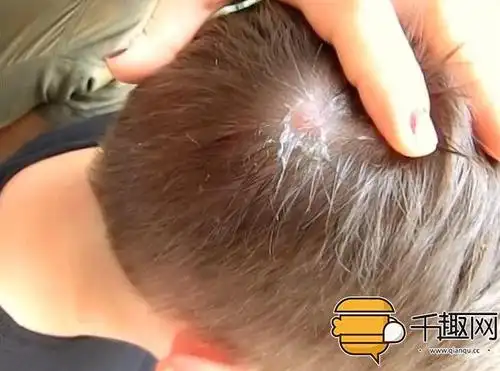 男子头上竟寄生了一直大蛆虫慎入小心会吐