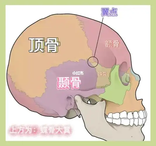 翼点pterion:额顶颞蝶