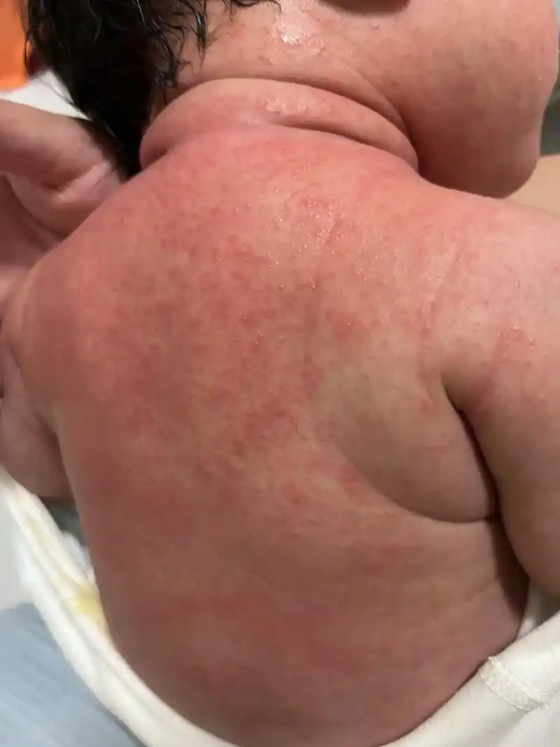 各各都说刚刚生的婴儿都会这样正常,要洗药草水四个