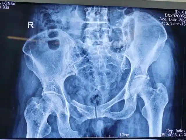 患者郭某,中年女性,于今年5月25日车祸受伤,伤及左下肢及左骶尾部