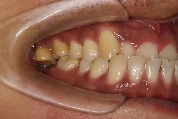 右下第二磨牙缺失,右上第二磨牙伸长,相片中的最后一颗牙齿!