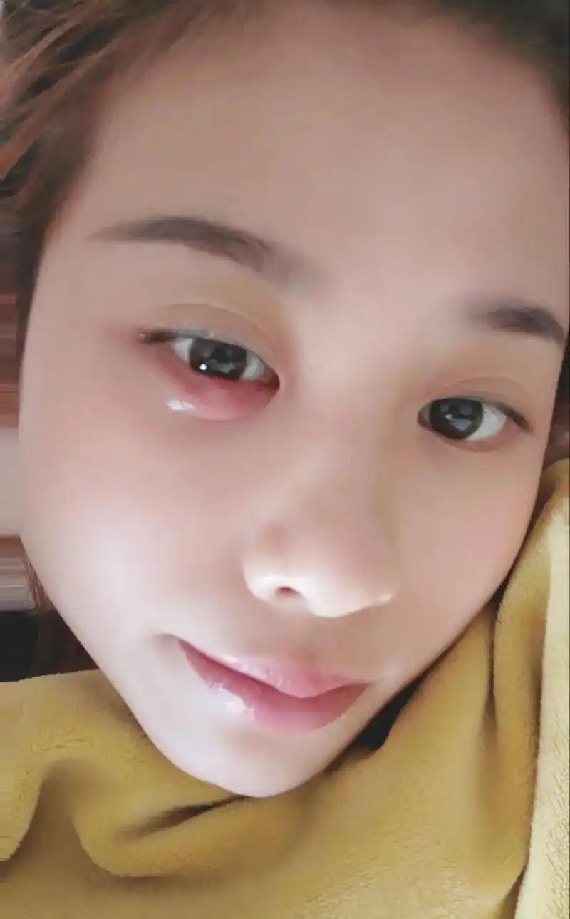 记录一下疫情在家感冒 眼上长个火疖子(俗称厥眼) 吃药  滴 - 抖音