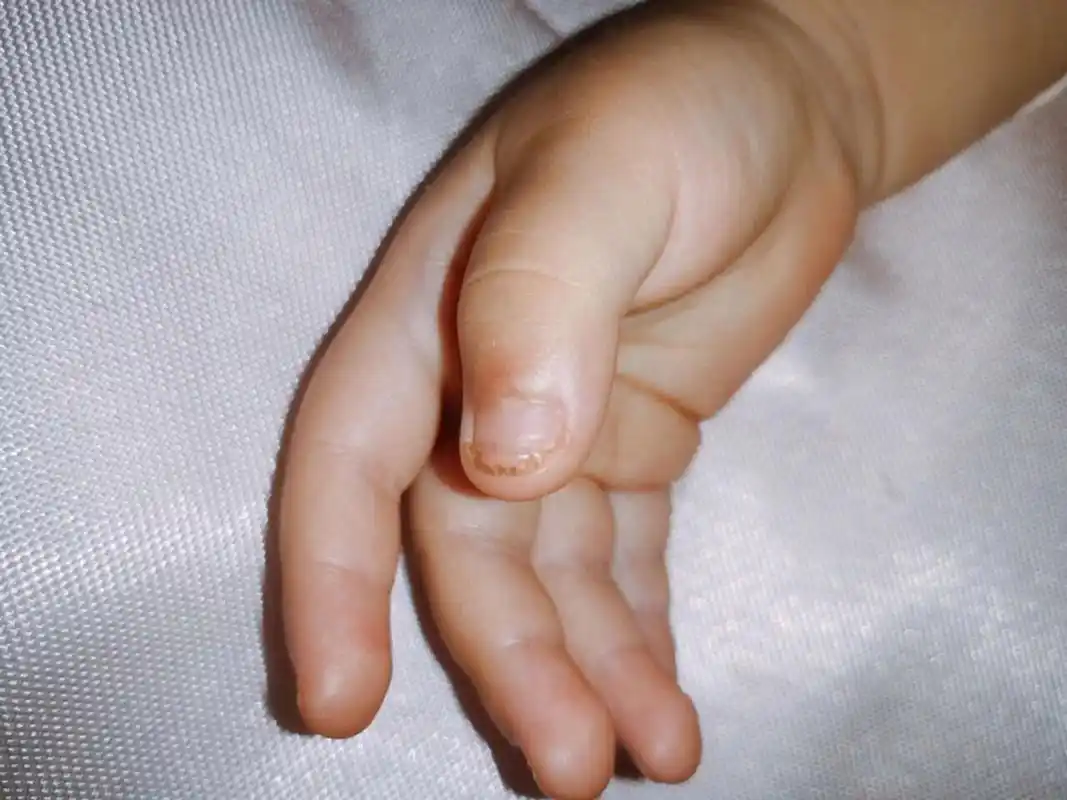 手指被夹后续—新指甲终于长好了 时隔一个多月,被门夹的指甲盖终于长