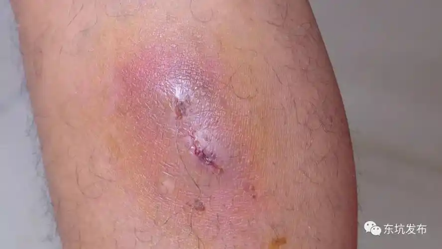 发痒,没有多加理会,谁知第二天早上起床发现左脚被咬伤的位置出现红肿