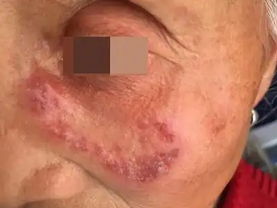 深在性红斑狼疮面部结节图.jpeg