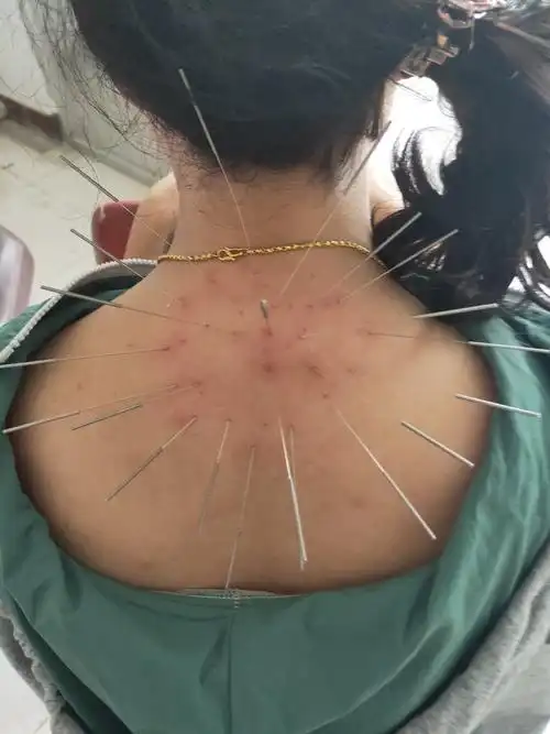 富贵包的针灸治疗