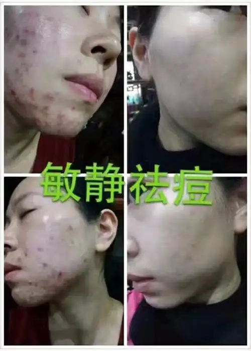 58元祛痘开始了