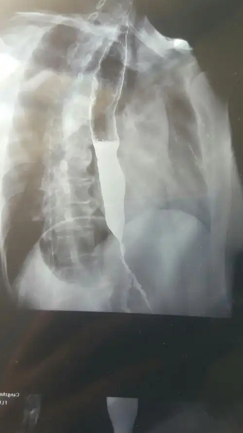 贲门失迟缓症的鸟嘴样改变