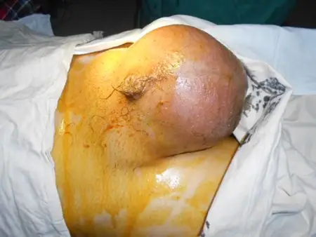 腹股沟疝多大才算大