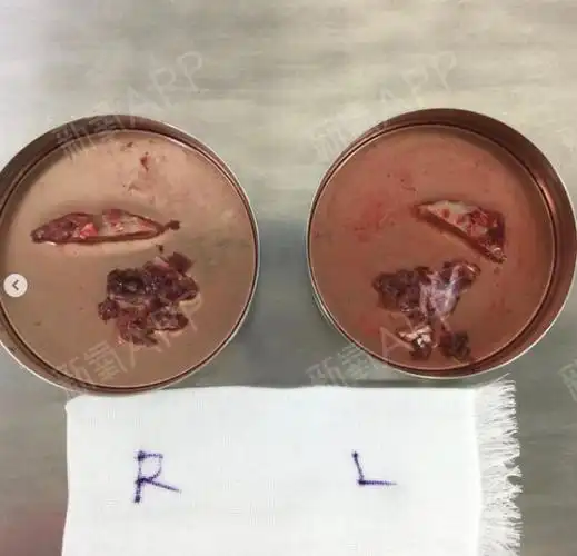 下颚骨切·咬肌切除