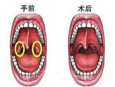 扁桃体恶性肿瘤扁桃体恶性肿瘤
